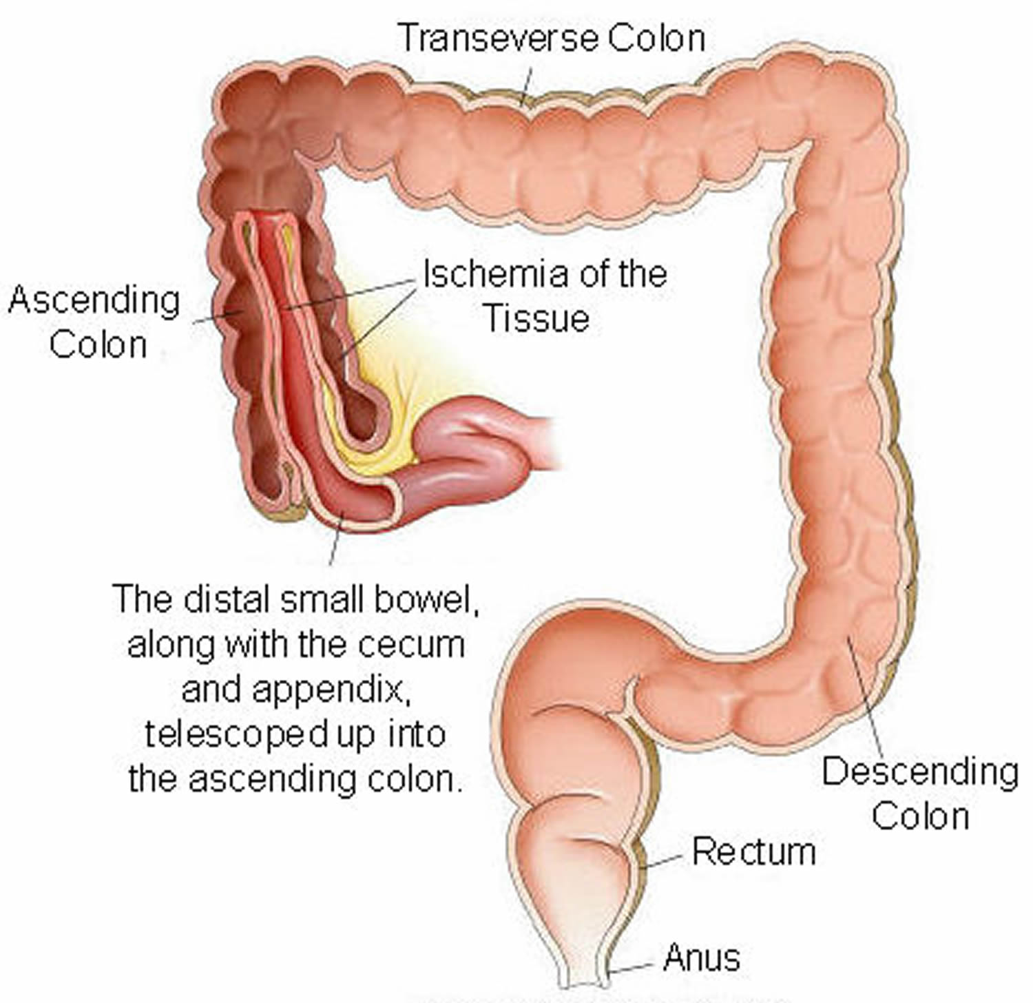 intestinal-obstruction-symptoms-and-causes-mayo-clinic